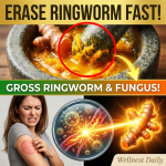 Erase Ringworm Fast! The 1-Ingredient “Golden Root” Pantry Hack to Destroy Skin Fungus